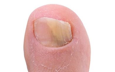 Symptoms of the presence of fungus in the leg thumb