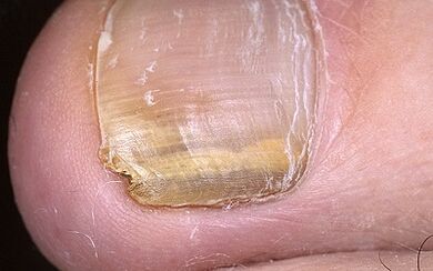 manifestations of the fungus in the thumb of the leg