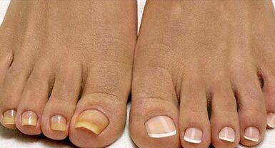 Fleet fungal treatment methods