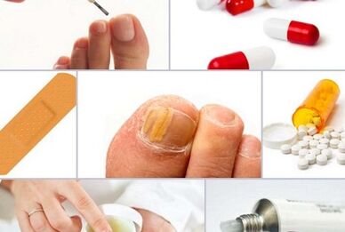 How to treat nail fungi