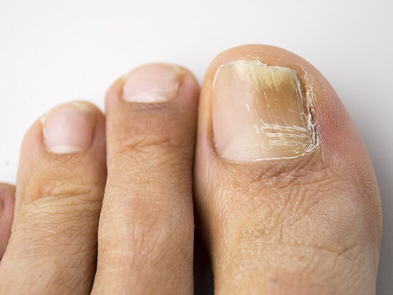 The early stage of the fungus