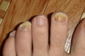 yellowing of the nail due to fungus