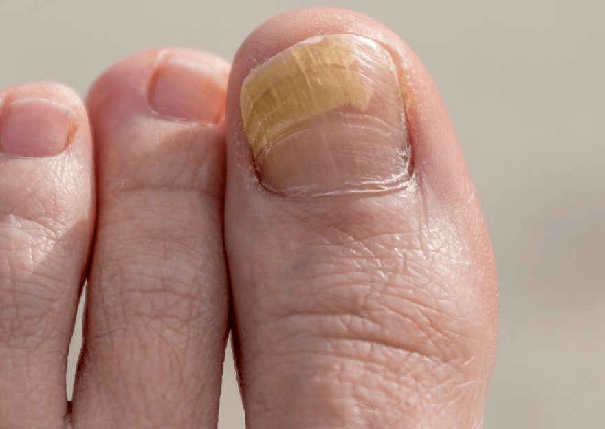 big toe nail fungus