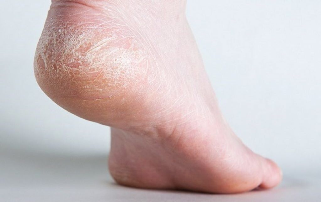 fungus on the skin of the feet